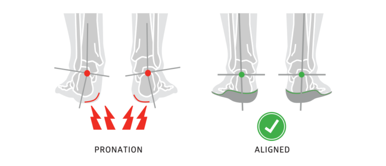 Are There Insoles That Help With Overpronation?